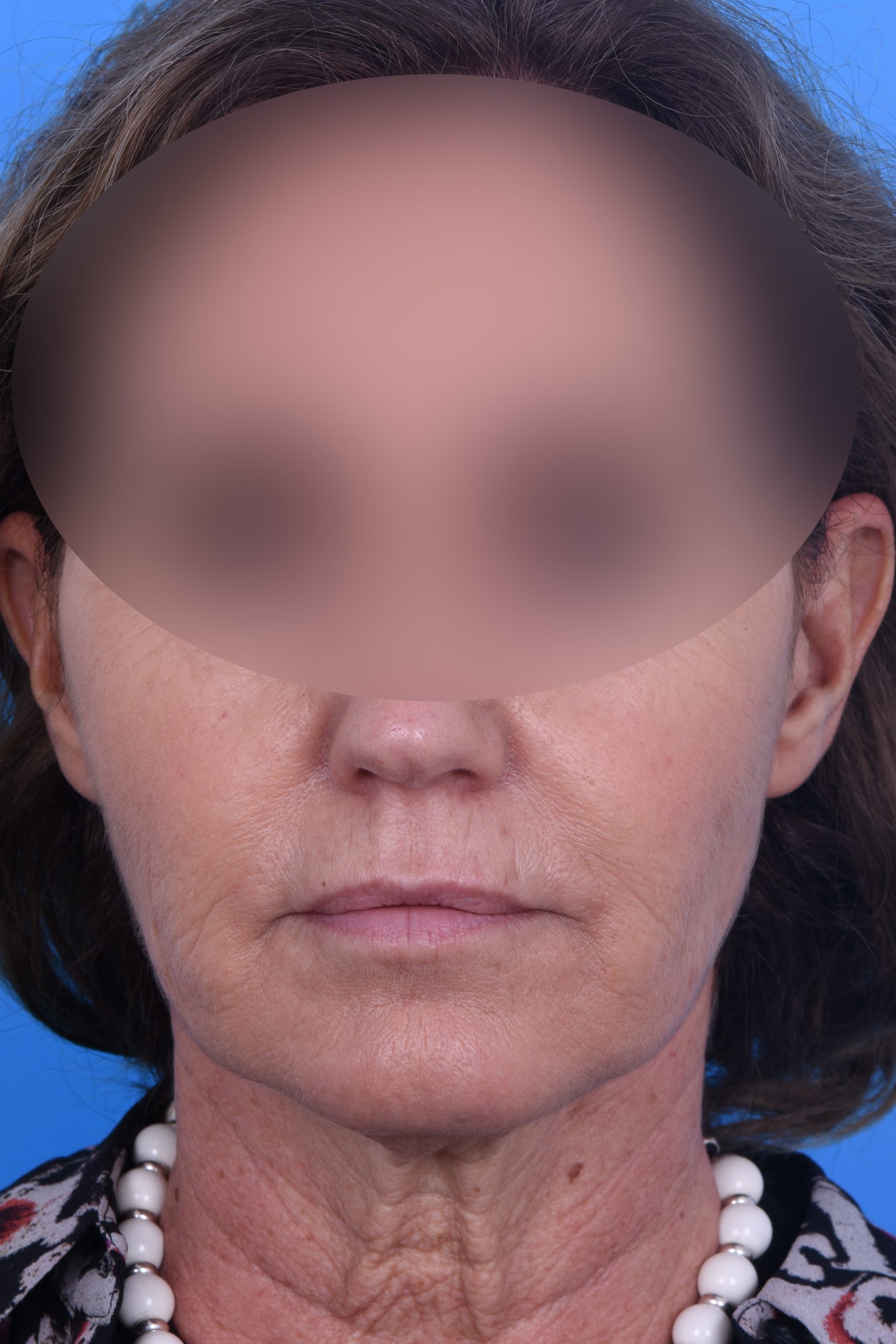 1 Vorher frontal