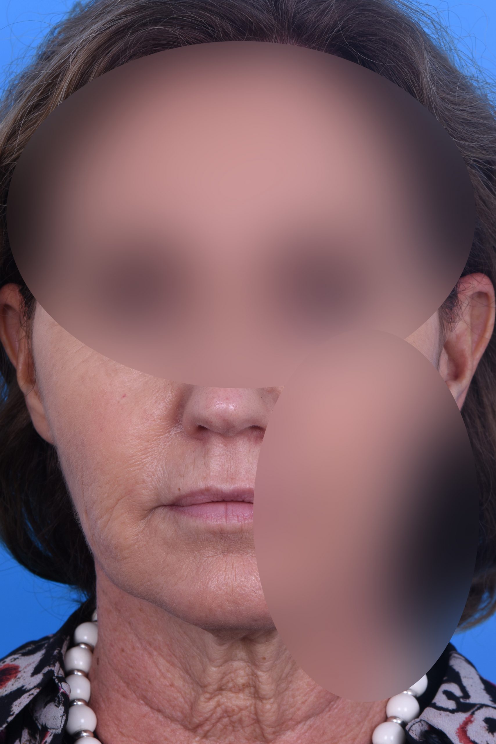 1 Vorher frontal double blur