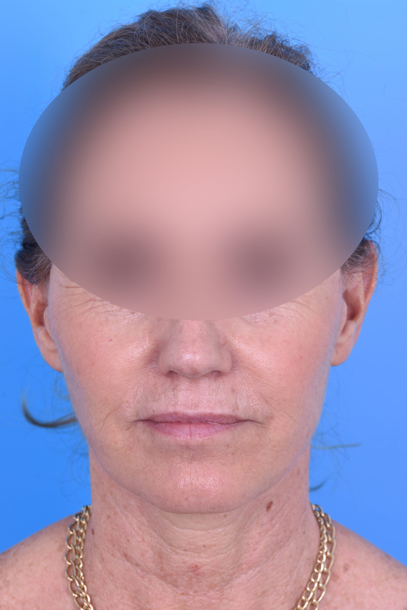 2 Nachher frontal