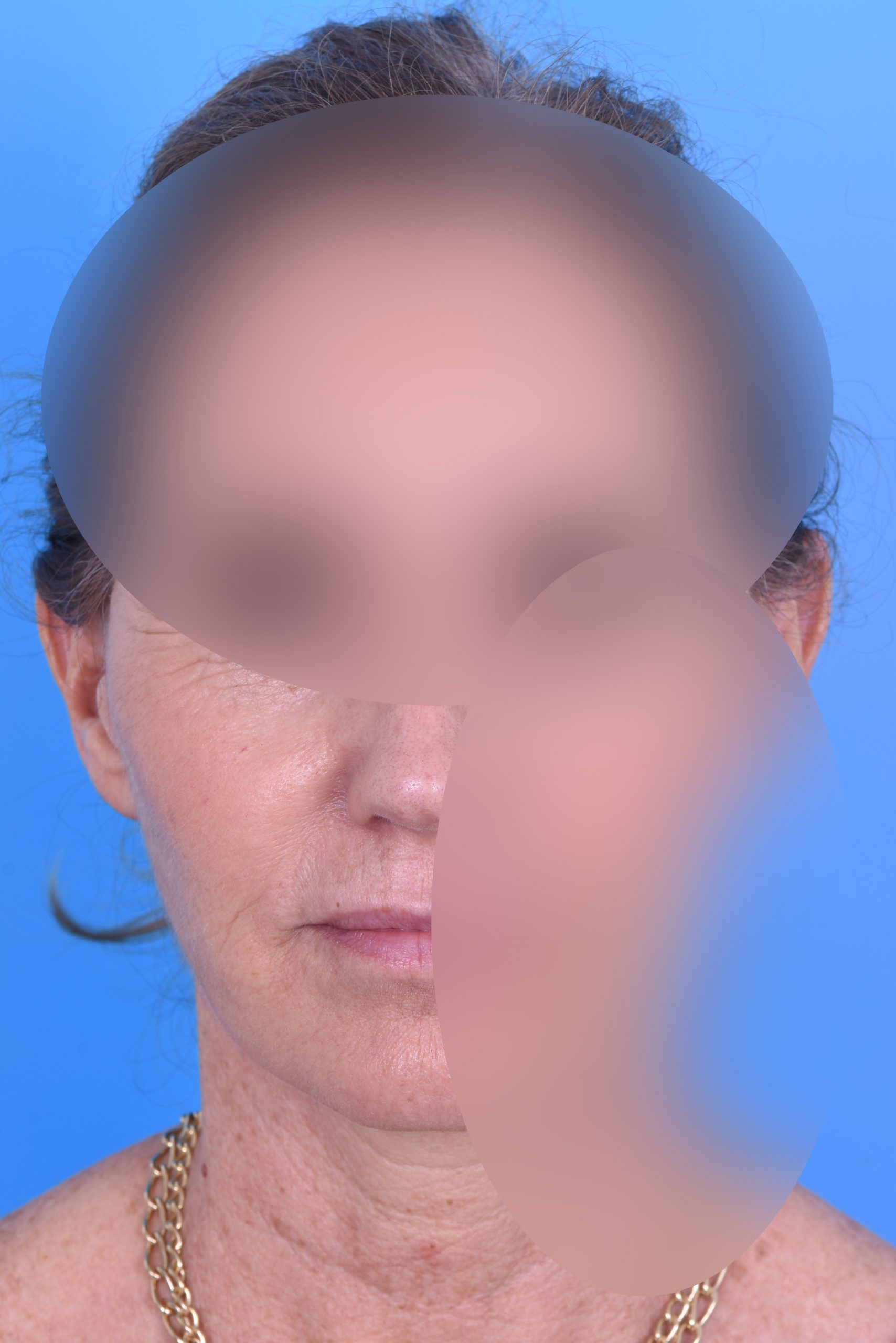 2 Nachher frontal double blur