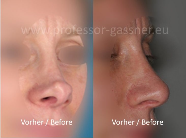 Nasenkorrektur Revision (Nachkorrektur) der Spitze Prof. Gassner