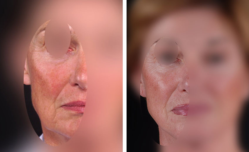 Facelift-1_vereint