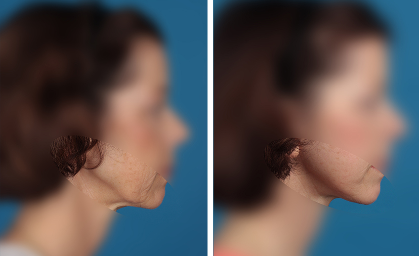 Facelift-2_vereint