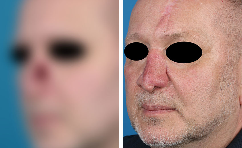 Nasenrekonstruktion bei einem Patienten (Vorher/Nachher) Prof. Gassner
