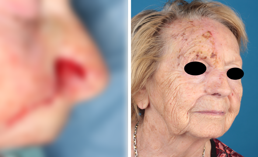 Nasenrekonstruktion (Vorher/Nachher) einer Patientin von Dr. Gassner