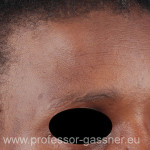 Stirn einer Frau mit Lipom operiert von Prof. Gassner