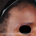 Stirn mit Lipom einer Patientin von Prof. Gassner