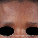 Stirn einer Frau mit Osteom operiert von Prof. Gassner