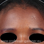 Operierte Stirn einer Patientin von Prof. Gassner
