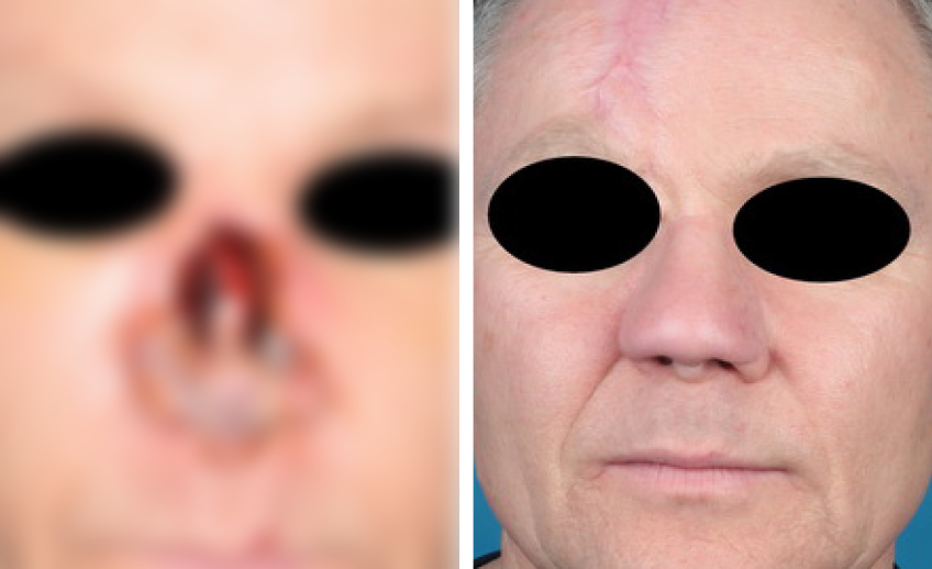 Nasenrekonstruktion Prof. Dr. med. Gassner (Regensburg/Nürnberg) Nasenrekonstruktion (Vorher/Nachher) – Foto eines Patienten